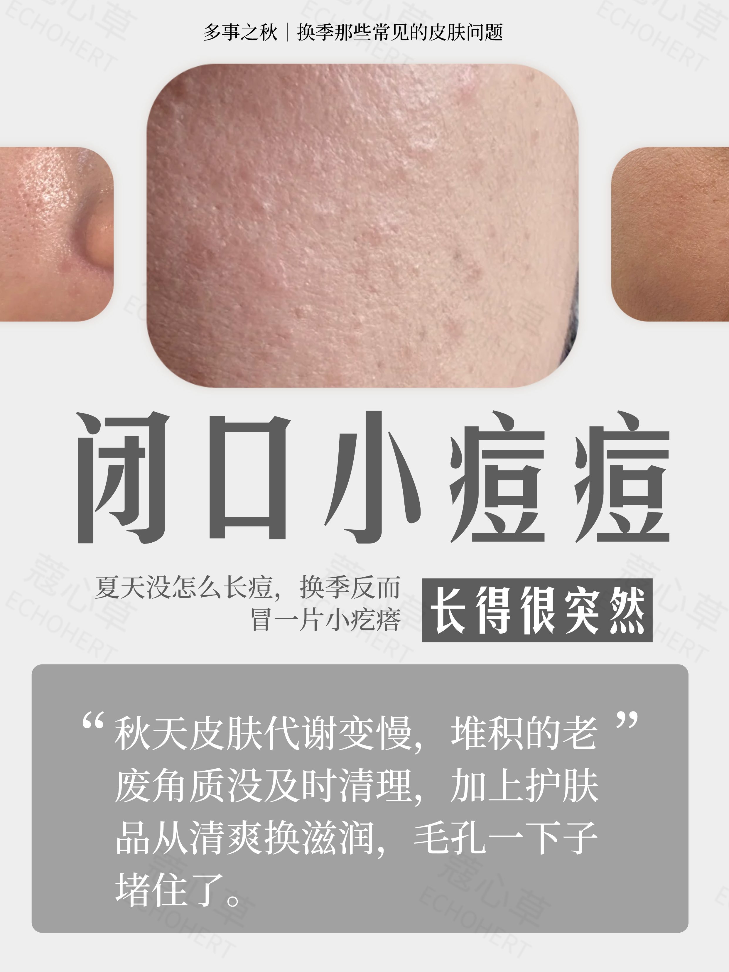 夏秋换季，秋天皮肤变差4.jpg